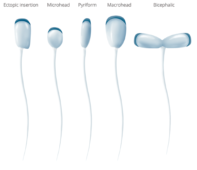 Spermatozoa abnormal forms head